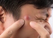 Cara Mengobati Bisul dengan Pengobatan Tradisional, Terbukti!